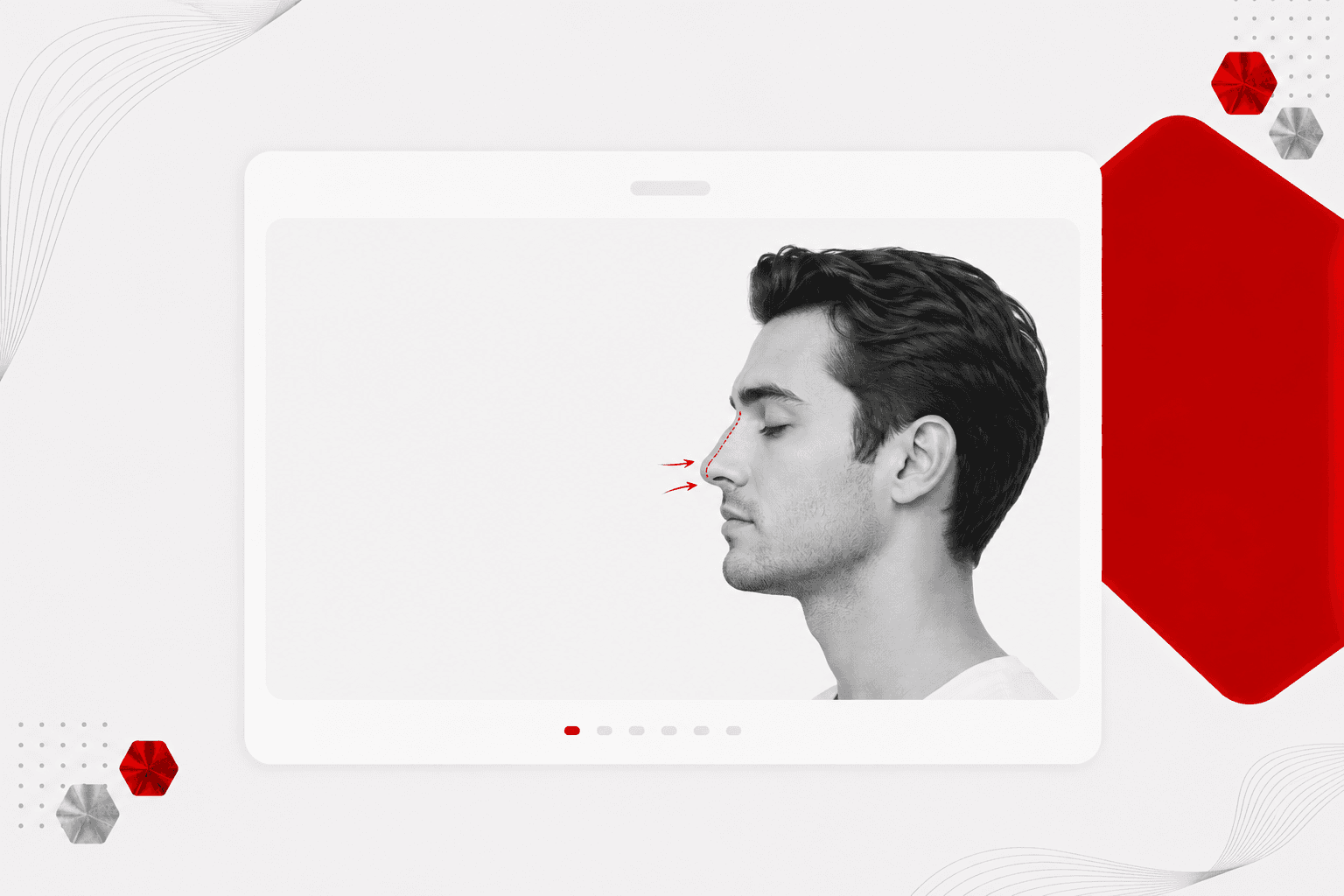 Male Rhinoplasty