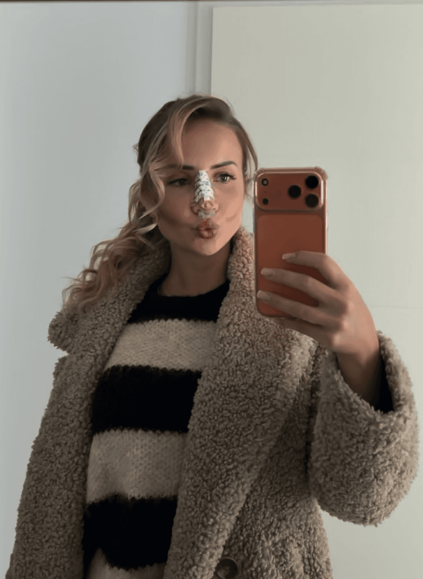 Alina – Primary Rhinoplasty